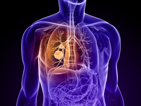 Lung Biopsy by OrangeCountySurgeons.org - 2